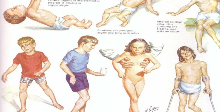 पक्षाघात का बढता प्रभाव 1 Para