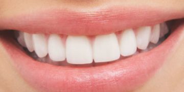 white teeth